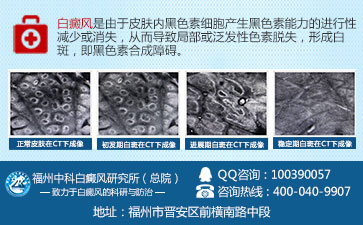 背上白癜风怎么出现的