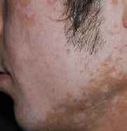 白癜风就是黑色素缺失吗