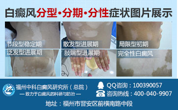 白癜风扩散的原因是什么