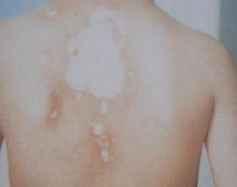 白癜风有哪些病因