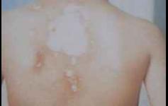 白癜风有哪些病因