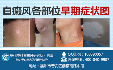 检查白癜风需要验血吗