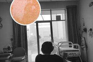 倍他米松注射剂是不是封闭针